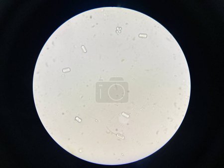 Foto de Vista microscópica de cristales de estruvita de sedimentos urinarios. Cristales de fosfato de magnesio y amonio. Causando Enfermedad del Tracto Urinario Inferior Felino - Imagen libre de derechos