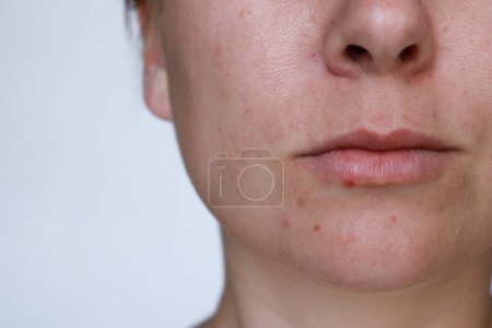 Téléchargez les photos : Fermer femme naturelle mauvaise peau d'acné avec des cicatrices. Photo de haute qualité - en image libre de droit