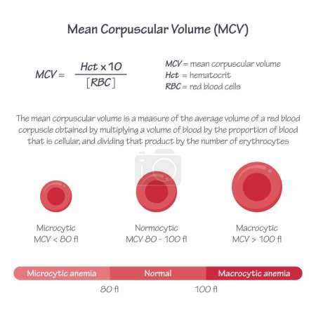 Ilustración de Media de volumen corpuscular MCV vector médico ilustración gráfica - Imagen libre de derechos