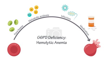 Illustration for G6PD Deficiency Hemolytic Anemia medical vector illustration graphic - Royalty Free Image