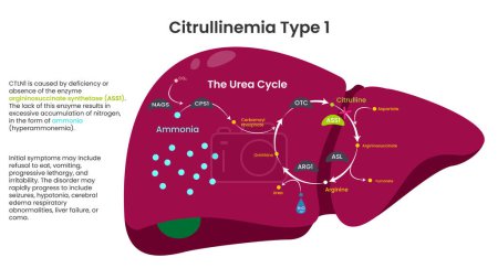 Ilustración de Citrullinemia Tipo 1 ASS1 Deficiencia vector informativo - Imagen libre de derechos