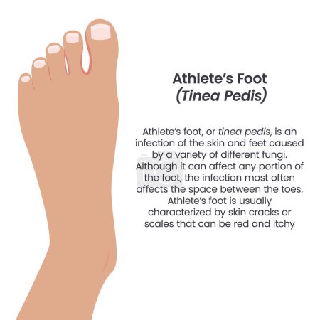 Illustration for Athletes foot tinea pedis - Royalty Free Image