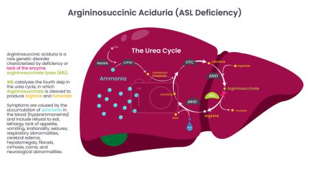 Ilustración de Argininosuccinic Aciduria ASL Diagrama vectorial de la deficiencia - Imagen libre de derechos