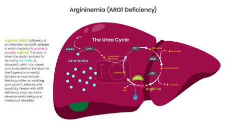 Illustration for Argininemia, Arginase ARG1 Deficiency vector diagram illustration - Royalty Free Image