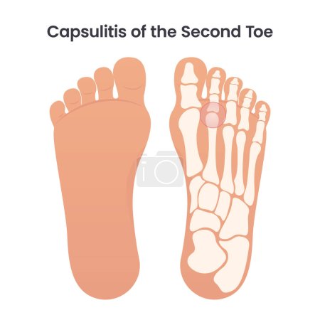 Capsulitis of the Second Toe medical vector illustration graphic