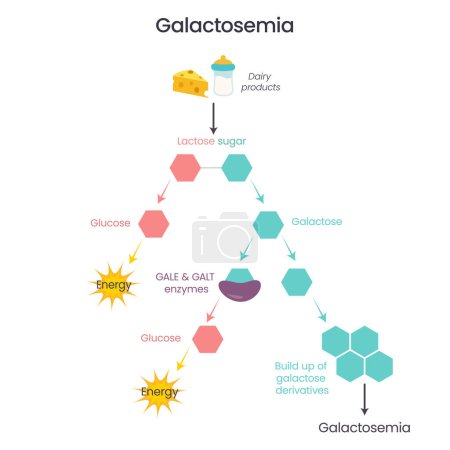 Illustration for Galactosemia GALE GALK GALT Enzymatic Deficiency science vector illustration infographic - Royalty Free Image