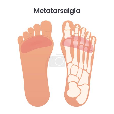 Illustration for Metatarsalgia medical vector illustration graphic - Royalty Free Image