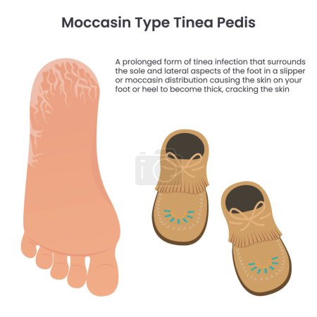 Illustration for Moccasin type tinea pedis medical vector illustration - Royalty Free Image
