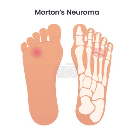 Téléchargez les illustrations : Illustration vectorielle éducative médicale du neurome de Morton graphique - en licence libre de droit
