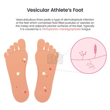 Ilustración de Infografía vectorial educativa de pie de atleta vesicular - Imagen libre de derechos