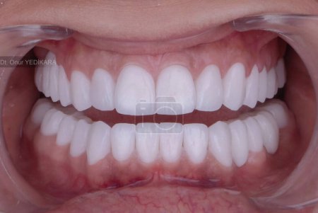 A total of sixteen zirconium coatings, the upper eight and the lower eight. Close-up shot. Dental concept.