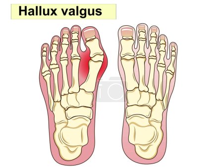 Illustration for Hallux valgus. Anatomy. Human foot bon Anatomy. Human foot bones. The main parts that make up the foot are shown. For basic medical education. Signatures and text. Also for clinics set - Royalty Free Image