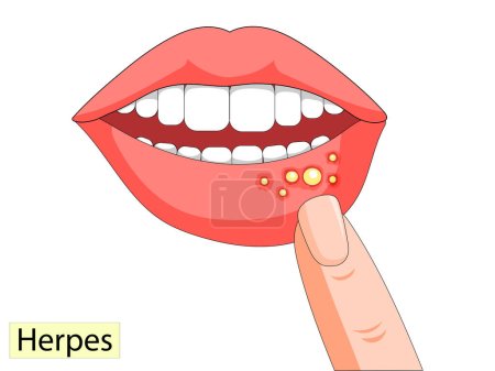 vector illustration of infection on female lips. Herpes