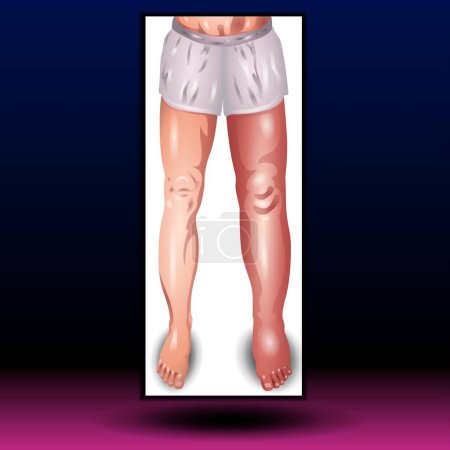 Photo for Swelling Leg - Fla source file available - Lymphedema. Lower extremity lymphatic obstruction. Comparison and difference of Healthy leg, and leg with lymphatic insufficiency. Overweight problem. elephantiasis. Disorder in the lymphatic system. - Royalty Free Image