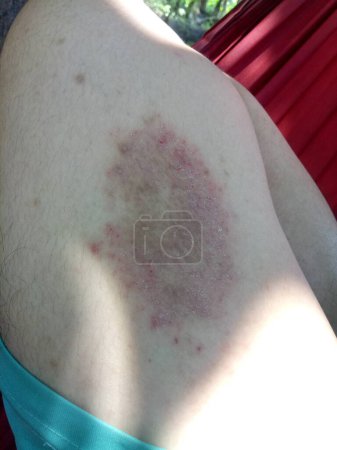 Foto de Tinea Corporis o infección fúngica de los muslos de los adolescentes. Esta es una infección dermatofita superficial. - Imagen libre de derechos