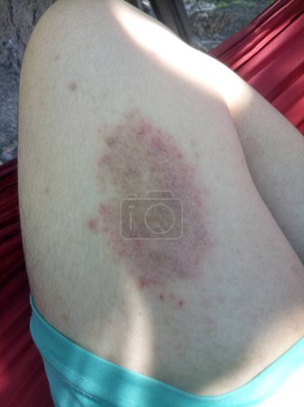 Foto de Tinea Corporis o infección fúngica de los muslos de los adolescentes. Esta es una infección dermatofita superficial. - Imagen libre de derechos