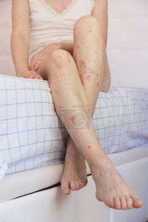 Primer plano de una persona sosteniendo una pierna. Detalle corporal de la mujer caucásica que muestra aceptación a pesar de tener problemas de piel. Concepto de inclusión y autoestima.