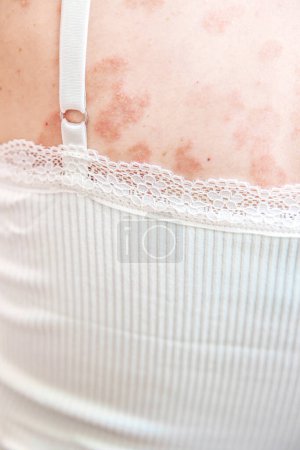 Detail eines Rückenteils des Körpers einer kaukasischen Frau mit Hautproblemen.