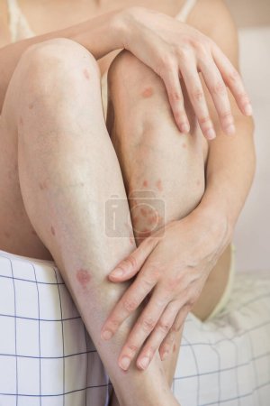 Primer plano de una persona sosteniendo una pierna. Detalle corporal de la mujer caucásica que muestra aceptación a pesar de tener problemas de piel. Concepto de inclusión y autoestima.