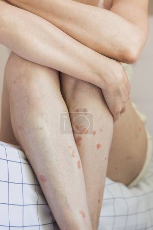 Nahaufnahme einer Person, die ein Bein hält. Körperdetail einer Kaukasierin, die Akzeptanz zeigt, obwohl sie Hautprobleme hat. Konzept der Inklusion und Selbstachtung.