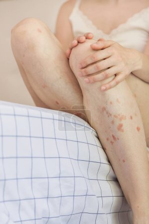 Close up of a person holding a leg. Body detail of Caucasian woman showing acceptance despite having skin problems. Concept of inclusion and self esteem.
