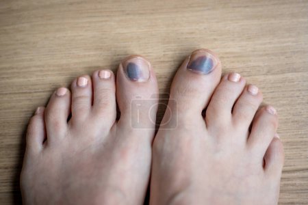 Feet in need of treatments, injuries and nail bruising. Concept, illustrative of need for health care, pedology or dermatology. Close up