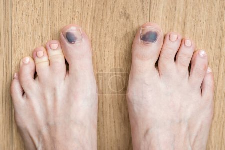 Feet in need of treatments, injuries and nail bruising. Concept, illustrative of need for health care, pedology or dermatology. Close up