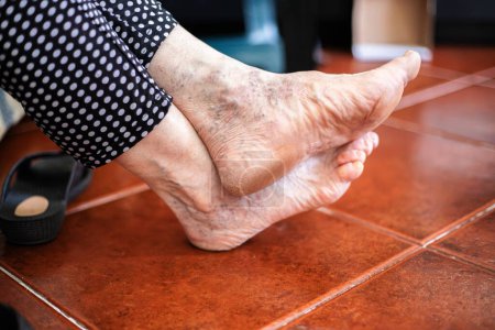 Gros plan des pieds nus d'une personne adulte avec divers problèmes de santé, callosités, peau sèche, oignons, ongles avec mycoses et varices.