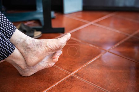 Primer plano de los pies desnudos de una persona adulta con varios problemas de salud, callos, piel seca, juanetes, uñas con micosis y venas varicosas.