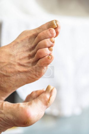 Primer plano de los pies adultos con diversos problemas, callos, piel seca, juanetes, uñas con micosis y varices.