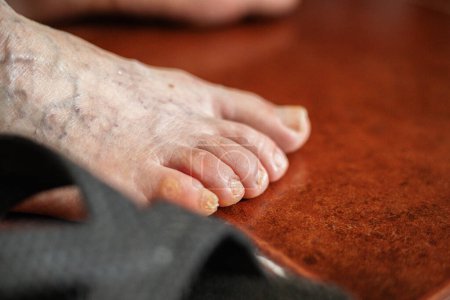 Gros plan des pieds nus d'une personne adulte avec divers problèmes de santé, callosités, peau sèche, oignons, ongles avec mycoses et varices.