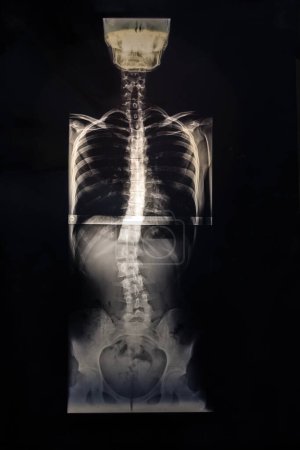 X-ray image of the spine of a patient with scoliosis. Radiography case study. Vertical image