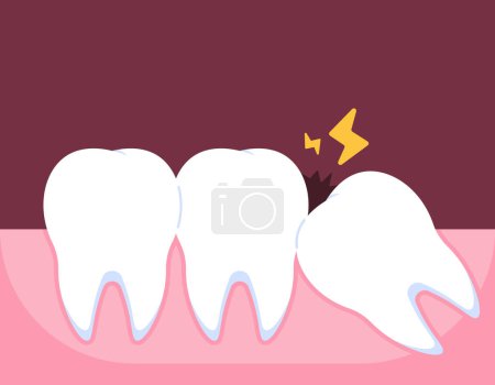 Illustration for Illustration of a wisdom tooth that is starting to grow. Wisdom teeth grow obliquely. the onset of pain due to tooth impaction. problems and pain. illustration concept design. vector elements - Royalty Free Image