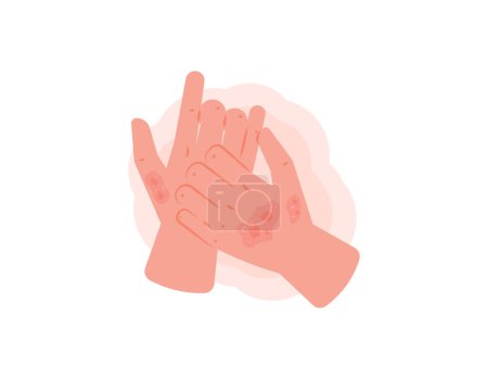 Illustration for Psoriasis. illustration of hands that feel itchy and a rash appears. inflammation of the skin that causes the skin to become scaly, thickened and itchy. disease or health problem. symbol or sign - Royalty Free Image