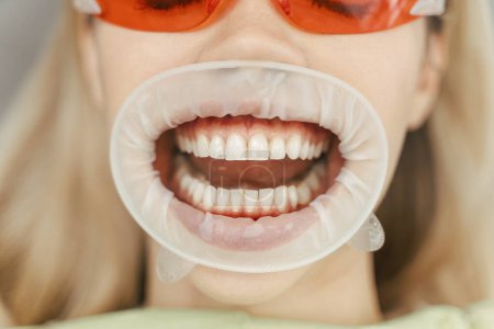 Téléchargez les photos : Jeune femme attrayante avec les cheveux blonds dans des lunettes rouges avec la bouche ouverte assis dans la chaise dentaire, blanchiment et le traitement des dents. Patiente visite chez le dentiste, contrôle, procédures dentaires - en image libre de droit