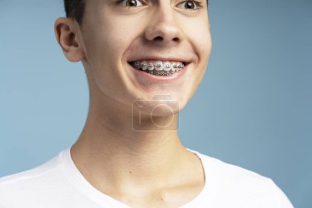 Photo for Attractive excited boy with orthodontic braces looking away standing isolated on blue background. Concept of dental, treatment - Royalty Free Image