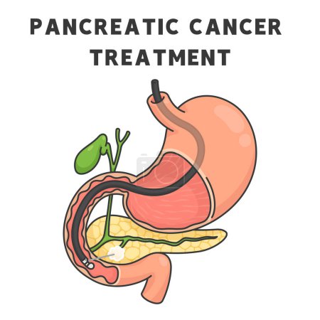 Illustration for Pancreatic cancer treatment chart in science subject kawaii doodle vector cartoon - Royalty Free Image