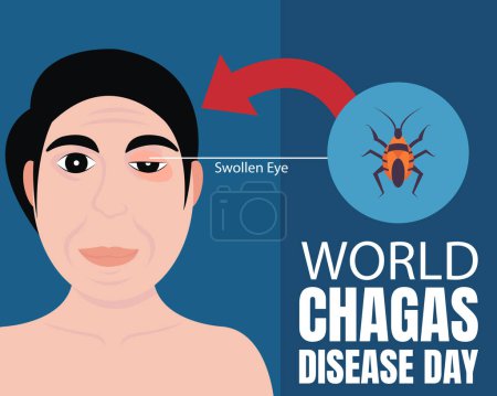 Ilustración de Illustration vector graphic of a man has been bitten by a kissing bug on his eyelid, perfect for international day, world chagas disease day, celebrate, greeting card, etc. - Imagen libre de derechos