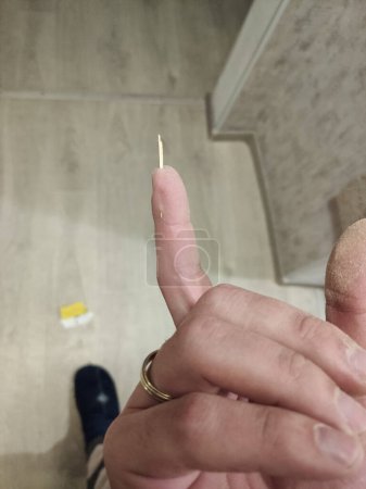 una astilla de madera en un dedo en la mano de un hombre