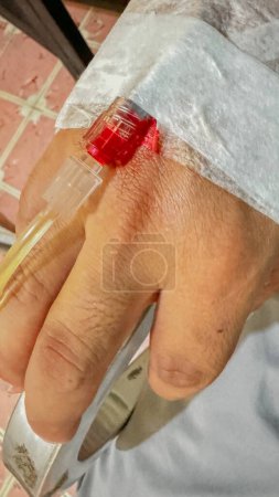 Closeup of a real patient's hand with intravenous infusion. (IV)blood transfusion concept