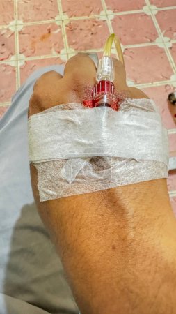 Closeup of a real patient's hand with intravenous infusion. (IV)blood transfusion concept