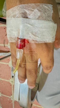 Primer plano de la mano de un paciente real con perfusión intravenosa. IV) concepto de transfusión de sangre