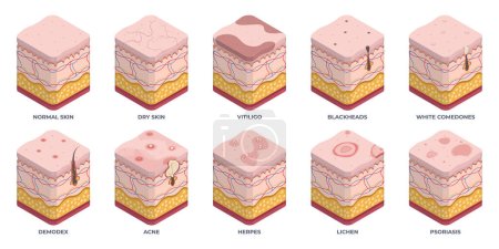Isometric human skin types, 3d epidermis layers. Dermatology normal, oily and dry epidermis, skin structure problems, wrinkles, acne and rosacea flat vector illustration set. Epidermis layers