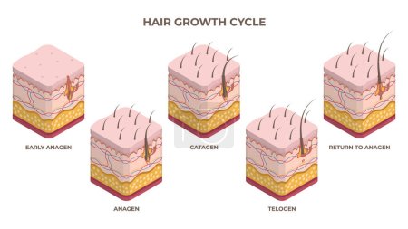 Ilustración de Ciclo de crecimiento isométrico del cabello, anágeno, telógeno, fases de catágeno. Capas de piel humana con pelo folículo crecimiento conjunto de ilustración vector plano. Etapas de crecimiento del cabello - Imagen libre de derechos