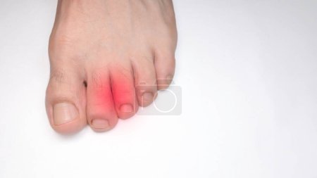 Ein linker Fuß Zehen einer Person mit einem roten Fleck, der Schmerz symbolisiert