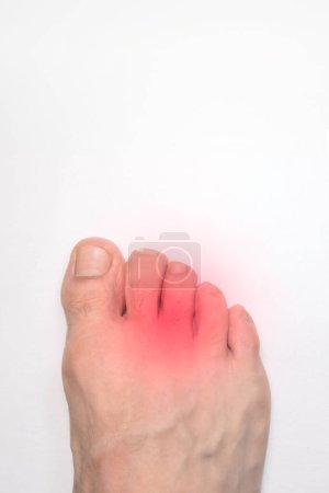 A Right foot toes of a person with a red mark representing pain