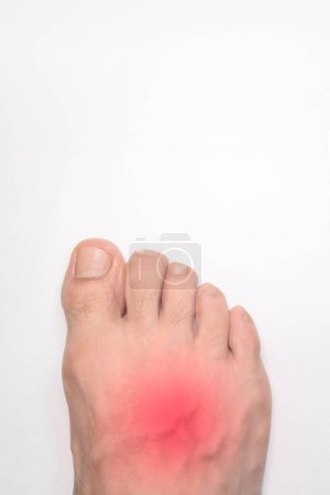 Ein Spann des rechten Fußes mit einer roten Markierung, die den Schmerz symbolisiert, mit Platz für Text oben