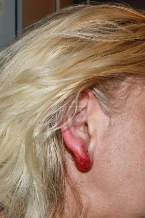Photo for Inflamed and bloody earlobe after ear piercing - Royalty Free Image