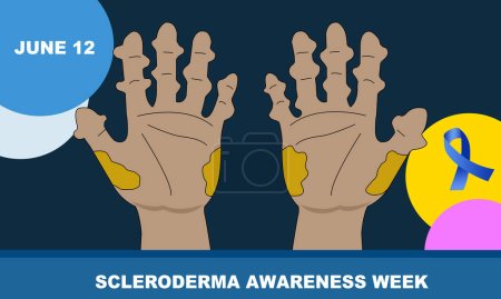 Illustration for A pair of hands with a rare disease called SCLERODERMA. an autoimmune connective tissue and rheumatic disease that causes inflammation in the skin and other areas of the body. SCLERODERMA AWARENESS - Royalty Free Image