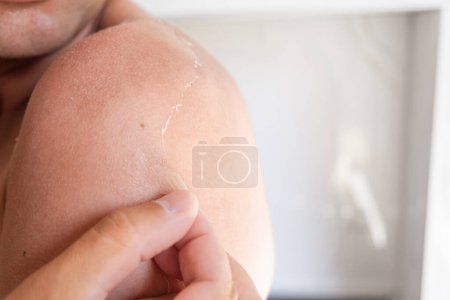 Téléchargez les photos : Exfoliation de la peau après coup de soleil. L'homme épluche la peau avec une main sur les épaules. La peau se détache, brûlée. Concept de soins de la peau - en image libre de droit